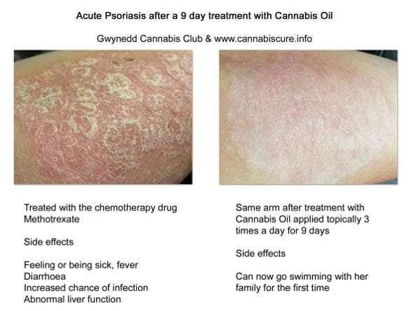 cannabis medical treatments