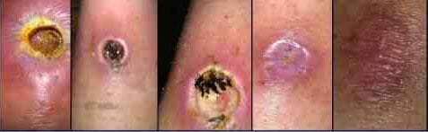 cannabis treatment